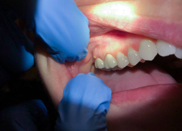 Best Emergency Tooth Extraction in Charlotte, TN