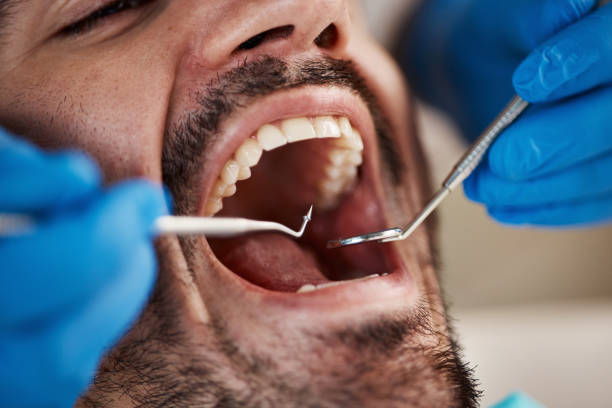 Best Emergency Wisdom Teeth Removal in Charlotte, TN